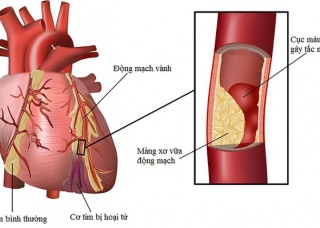 Ảnh 2 của Viêm động mạch
