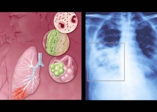 Ảnh 1 của Viêm phổi không điển hình
