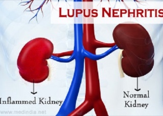 Ảnh 1 của Viêm thận lupus