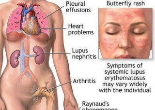 Ảnh 4 của Viêm thận lupus
