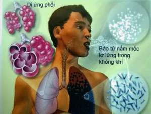 Ảnh 3 của Viêm phổi do nấm