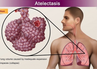 Ảnh 1 của Atelectasis