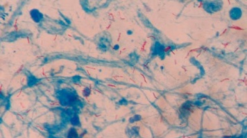 Tìm hiểu Vi khuẩn gây bệnh lao Mycobacterium tuberculosis trên người