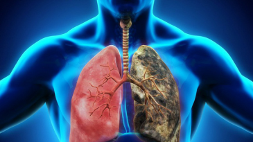 Vì sao cần tầm soát ung thư phổi?