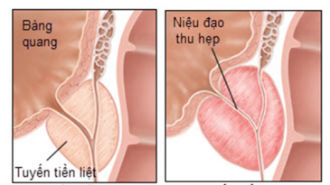 Dấu hiệu của bệnh viêm tiền liệt tuyến ở nam giới