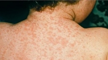 Rubella là bệnh gì? Nguyên nhân, triệu chứng, biến chứng và cách đề phòng