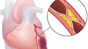 Chụp mạch vành - Trong Chẩn đoán và điều trị bệnh mạch vành