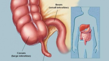 Viêm ruột thừa cấp những điều cần biết