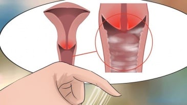 Viêm nhiễm âm đạo là nguyên nhân hàng đầu gây tắc ống dẫn trứng