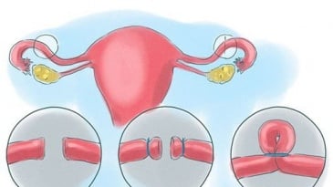 Thắt ống dẫn trứng có ảnh hưởng đến chu kỳ kinh nguyệt không?