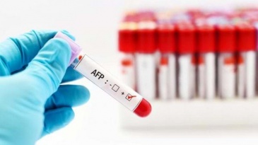 Có thể phát hiện ung thư gan qua xét nghiệm định lượng AFP hay không?