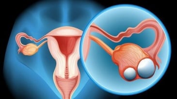 Mổ nội soi cho bệnh nhân ung thư buồng trứng giai đoạn sớm
