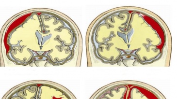 Chấn thương sọ não: Nhận biết và điều trị thế nào?