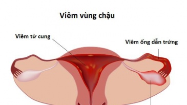 Viêm vùng chậu là bệnh gì? Nguyên nhân, triệu chứng và cách phòng ngừa