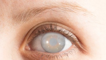 Bệnh đục thủy tinh thể có thể gây mù lòa - Cần phát hiện sớm để điều trị