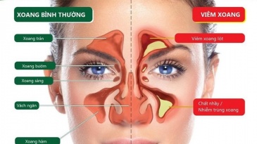 Cách chăm sóc người bị bệnh viêm xoang cấp