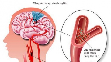 Thuốc tiêu sợi huyết Điều trị nhồi máu não