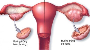 U nang buồng trứng là bệnh gì? Liệu có thể trở thành ung thư buồng trứng?