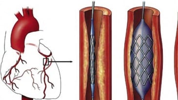 Nong mạch vành và đặt stent: Chỉ định, quy trình thực hiện, biến chứng có thể xảy ra