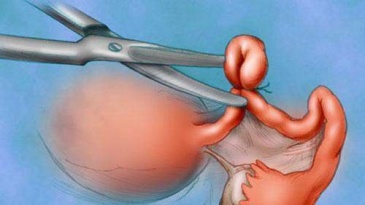 Phẫu thuật cắt tử cung - Những điều cần biết