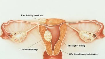 U xơ tử cung khi mang thai có nguy hiểm?