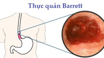 Các phương pháp điều trị bệnh Barrett thực quản