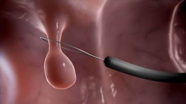 Polyp buồng tử cung là bệnh gì? Phẫu thuật cắt polyp qua soi buồng tử cung