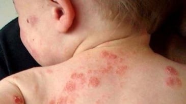 Dấu hiệu bệnh zona thần kinh ở trẻ em
