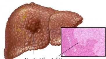 Ung thư biểu mô tế bào gan là gì? Triệu chứng, Chẩn đoán và Điều trị