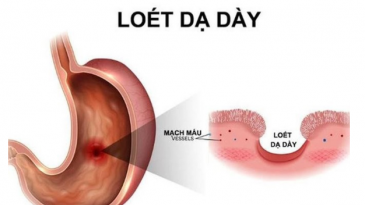 Các thể lâm sàng và loét dạ dày tá tràng