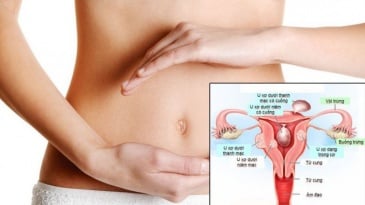 U xơ tử cung là bệnh gì? Nguyên nhân, triệu chứng, Cách phòng tránh