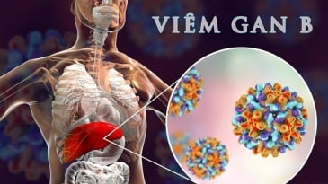 Vì sao nhiễm siêu vi viêm gan B có nguy cơ dẫn tới Xơ gan và ung thư gan?