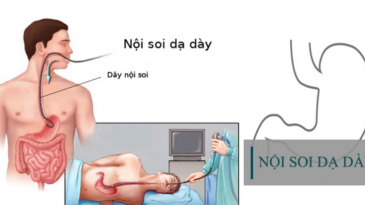 Tại sao phải nội soi dạ dày?