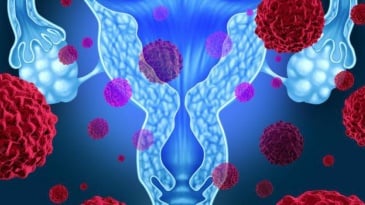 Phát hiện sớm và phân giai đoạn ung thư cổ tử cung