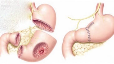 Phẫu thuật nội soi cắt 2/3 dạ dày