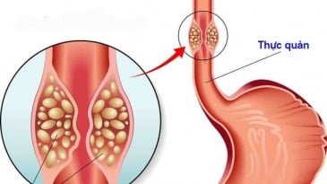 Cắt thực quản qua nội soi ngực bụng điều trị ung thư thực quản