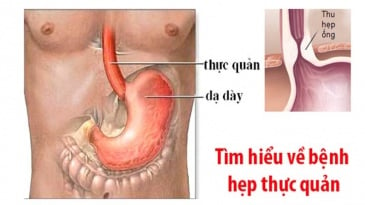 Điều trị hẹp tắc thực quản dưới hướng dẫn của chụp số hóa xóa nền