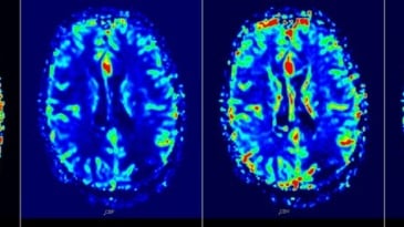 Chụp cộng hưởng từ tưới máu não (MRI perfusion) - P1