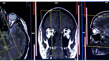 Chụp cộng hưởng từ hốc mắt và thần kinh thị giác