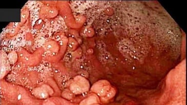 Tìm hiểu các polyp đại tràng có tính chất gia đình