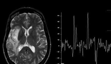 Chụp cộng hưởng từ phổ não (spect tính rography)
