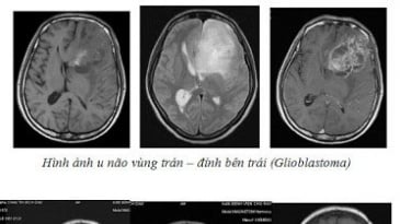 Chụp cộng hưởng từ tưới máu não: Những điều cần biết