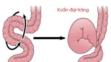 Tìm hiểu về bệnh xoắn đại tràng