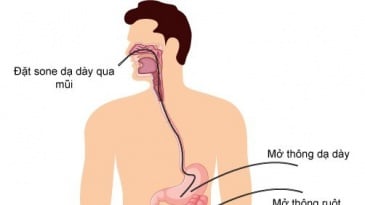 Mở thông dạ dày qua da dưới chụp mạch số hóa xóa nền