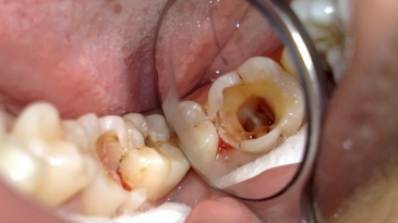Răng sâu nên bọc răng sứ hay trám răng?