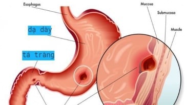 Viêm loét dạ dày thường tái phát vì sao?