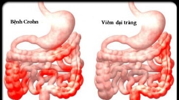 Bệnh vảy nến và mối liên với bệnh Crohn (viêm ruột từng vùng)