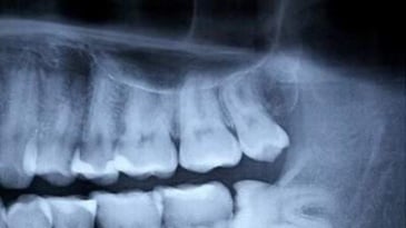 Khi nào nhổ răng khôn mọc lệch? và khi nào không lên nhổ răng khôn?
