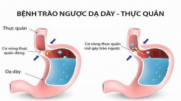 Bệnh trào ngược họng – thanh quản là gì?