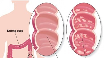 Phẫu thuật viêm loét đại tràng: Những điều cần biết